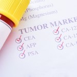 Ich obecność we krwi może sugerować raka. Czym są markery nowotworowe?