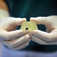  Nowatorski zabieg przeszczepu kości szczęki wykonali lekarze z poradni chirurgii stomatologicznej i implantologii szpitala im. Wojskowej Akademii Medycznej w Łodzi