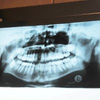  Nowatorski zabieg przeszczepu kości szczęki wykonali lekarze z poradni chirurgii stomatologicznej i implantologii szpitala im. Wojskowej Akademii Medycznej w Łodzi