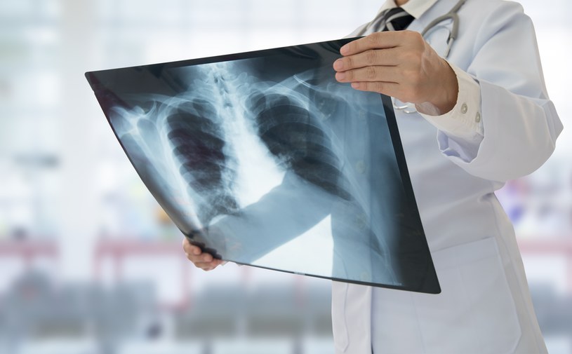 Idiopatyczne włóknienie płuc jest chorobą postępującą, która prowadzi do niewydolności oddechowej (zdj. ilustracyjne) /123RF/PICSEL /123RF/PICSEL