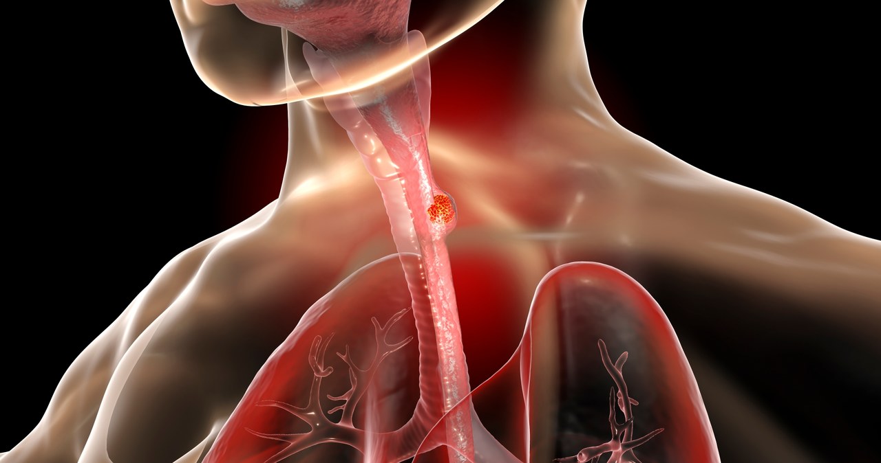Ilustracja 3D przedstawiająca nowotwór w ludzkim przełyku /123RF/PICSEL