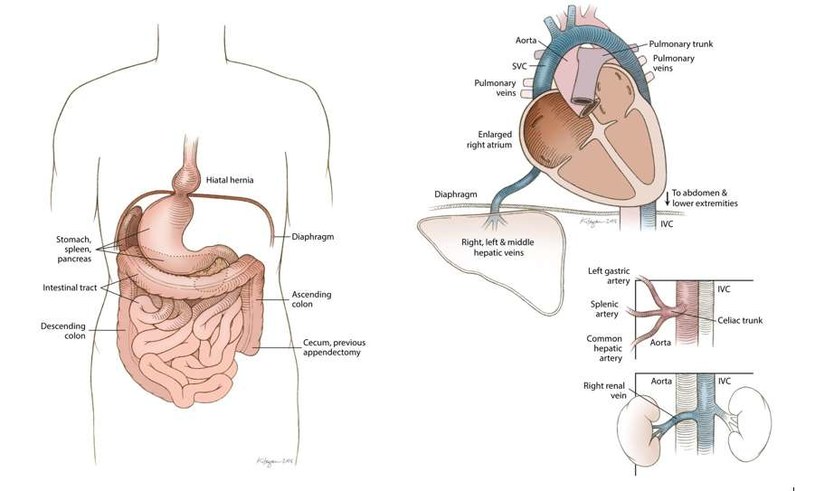 Ilustracja po lewej obrazuje situs inversus z lewokaridą u Rosie Marie Bentley, pozostałe schematy prezentują inne wady anatomiczne u zmarłej kobiety /Fot. Uniwersytet Oregonu /materiały prasowe