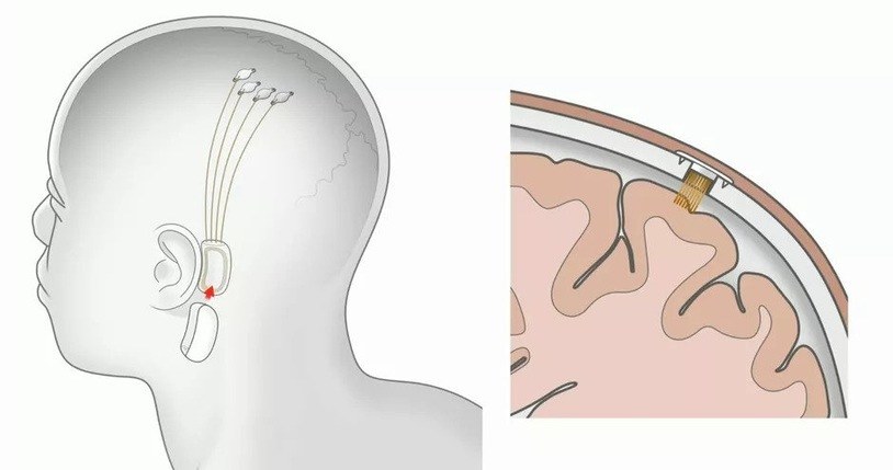 Implant przygotowany przez Neuralink /materiały prasowe