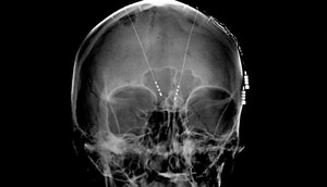 Implanty w mózgu przywrócą pamięć