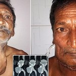 Indyjski rolnik po usunięciu 1,4-kilogramowego guza. Rósł przez 20 lat!
