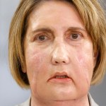 Infekcja "wyżarła" tej kobiecie twarz. Dostała nową dzięki eutanazji