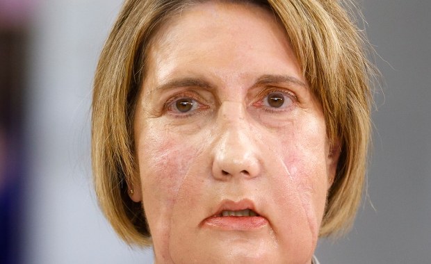 Infekcja "wyżarła" tej kobiecie twarz. Dostała nową dzięki eutanazji