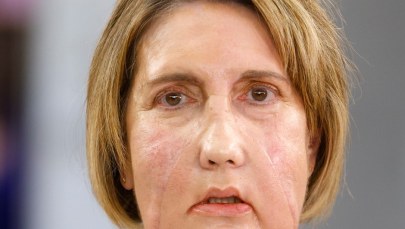 Infekcja "wyżarła" tej kobiecie twarz. Dostała nową dzięki eutanazji