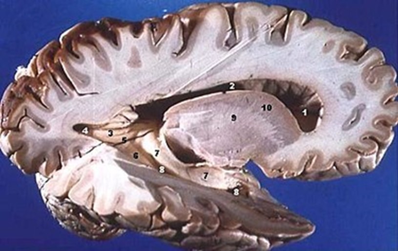 Istota biała to jaśniejsza część mózgu /John A Beal/CC BY 2.5 (https://creativecommons.org/licenses/by/2.5/deed.en) /Wikimedia