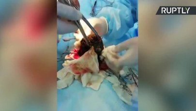 Jadła mało, a brzuch ciągle rósł. Z żołądka nastolatki usunięto 3,5-kilogramową kulę włosów