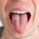 Jak leczyć grzybicę języka?