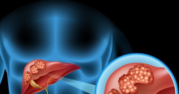 Jak objawia się nowotwór wątroby? /&copy;123RF/PICSEL