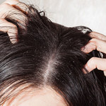 Jak pielęgnować włosy z łupieżem?