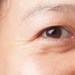 Jak pozbyć się opuchniętych oczu? Domowe sposoby