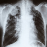 Jak pozbyć się wydzieliny z płuc syropem domowej roboty?