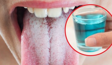 Jak prawidłowo stosować płyn do płukania jamy ustnej? Uważaj na te błędy