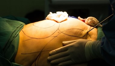 Jak przebiega liposukcja ultradźwiękowa?