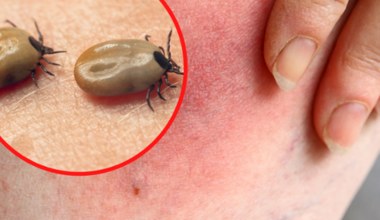 Jak rozpoznać boreliozę? Wczesne objawy choroby z Lyme