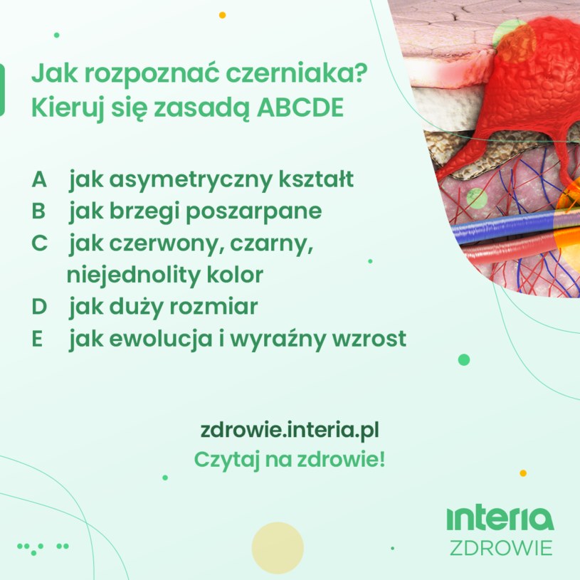 Jak rozpoznać czerniaka? Kieruj się zasadą ABCDE /INTERIA.PL