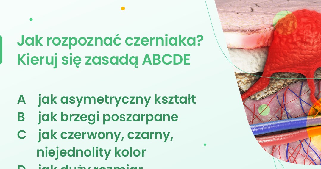 Jak rozpoznać czerniaka? Kieruj się zasadą ABCDE /INTERIA.PL