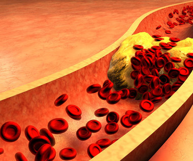 Jak skutecznie obniżyć cholesterol domowymi sposobami?