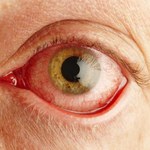 Jak stosować świetlik łąkowy w leczeniu infekcji i chorób oczu?