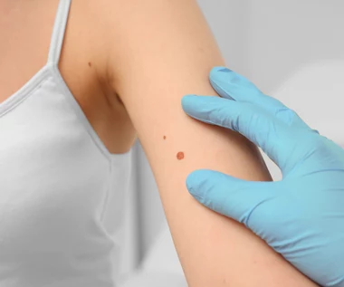 Jak wygląda czerniak? Jak diagnozuje się czerniaka? Ważne są też te badania
