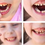 Jak wyrwać dziecku zęba? 