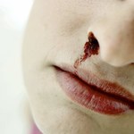 Jak zatrzymać krwawienie z nosa ?