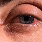 Jak zmniejszyć opuchliznę oka?