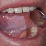Jakie są objawy raka jamy ustnej?