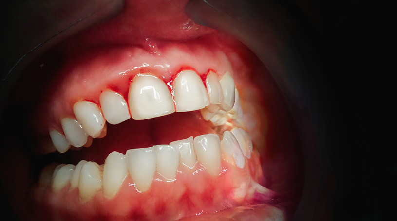 Jama ustna to środowisko rozwoju wielu drobnoustrojów. Dlatego tak ważna jest regularna higiena zębów /123RF/PICSEL