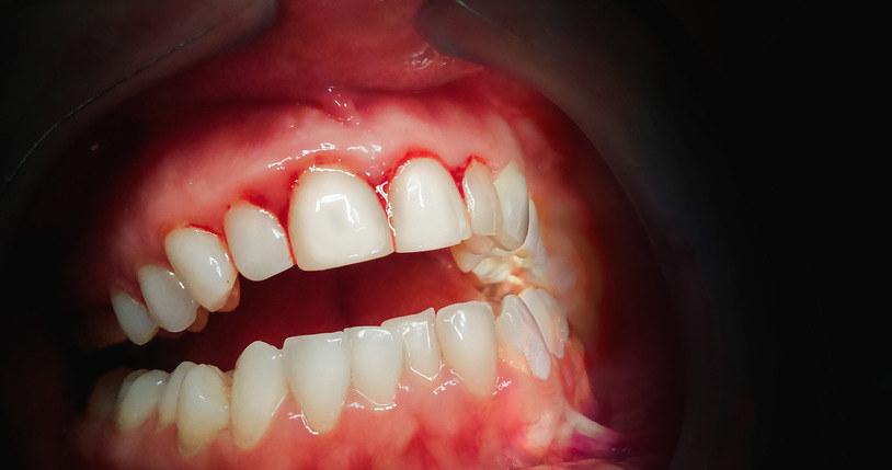 Jakie Choroby Powoduje Chory Ząb To Się Dzieje Gdy Nie Leczysz Zębów Kobieta W Interiapl 9433