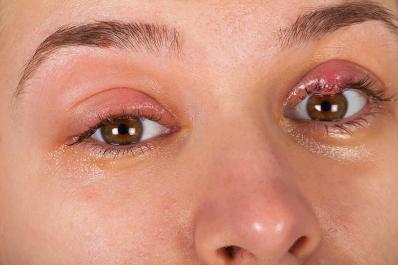 Jęczmień na oku jest wywoływany przez bakterię - gronkowca. Jeśli nie minie samoistnie, konieczna będzie maść z antybiotykiem na receptę /123RF/PICSEL