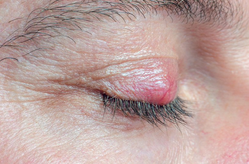 Jęczmień to jedna z możliwych przyczyn łzawienia oczu /123RF/PICSEL
