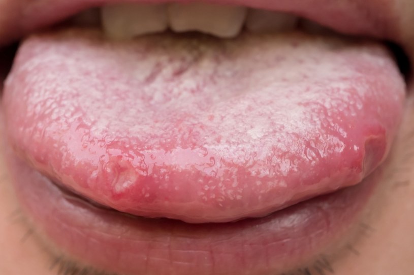 Jednym z objawów choroby nowotworowej jest nieestetyczny nalot w jamie ustnej /123RF/PICSEL