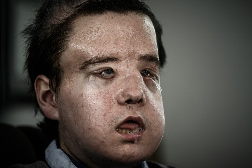 ​Jerome Hamon to pierwszy człowiek na świecie, który przeszedł drugi przeszczep twarzy /AFP