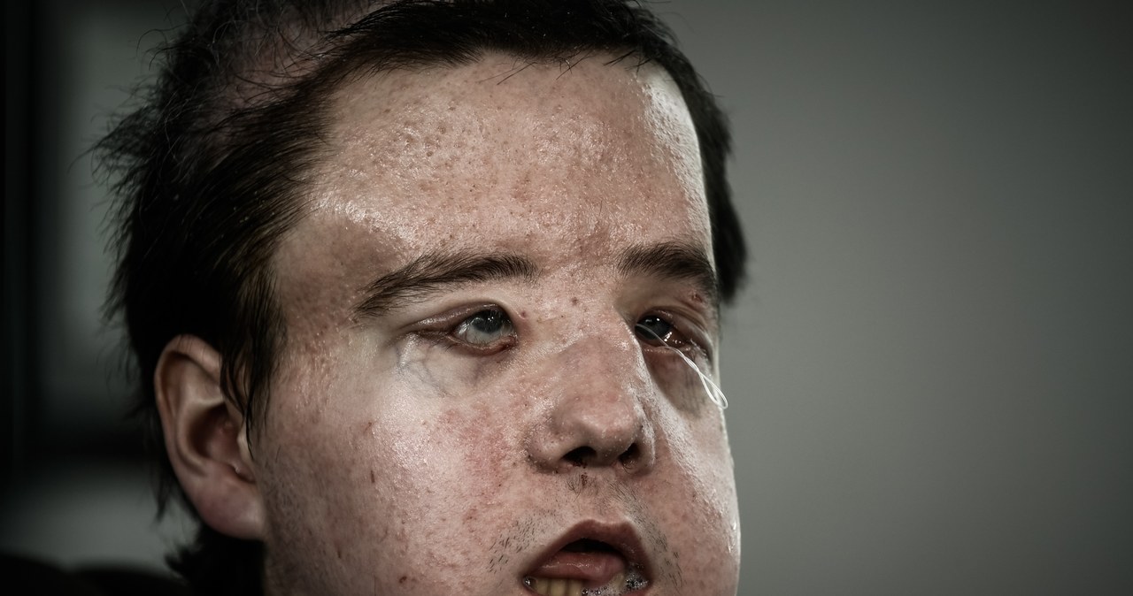 ​Jerome Hamon to pierwszy człowiek na świecie, który przeszedł drugi przeszczep twarzy /AFP