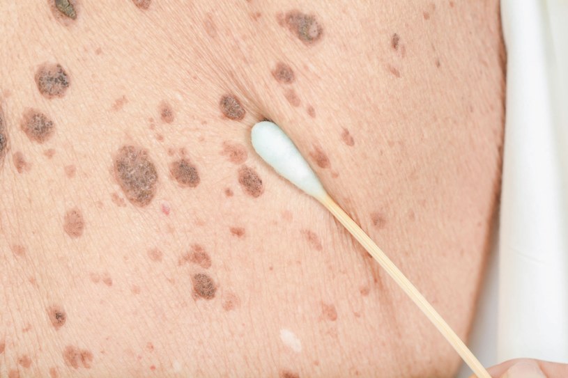 Jeśli zauważysz na ciele niepokojące zmiany, natychmiast udaj się do dermatologa /123RF/PICSEL