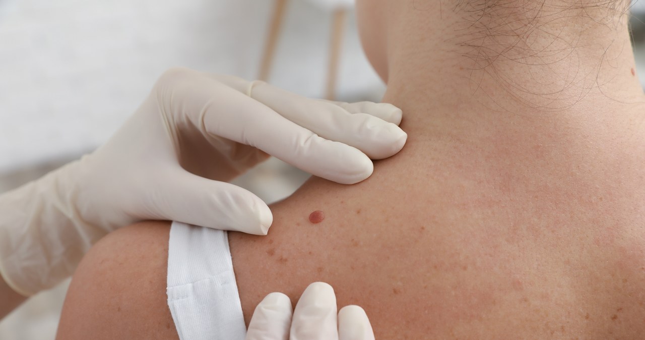 Jeśli zauważysz na skórze coś, co wyda ci się podejrzane, nie zwlekaj i udaj się do dermatologa /123RF/PICSEL