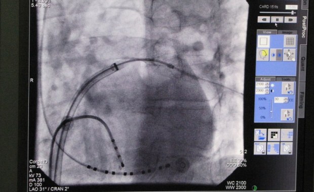Jest nadzieja dla osób po udarze. Nowy zabieg będzie refundowany?
