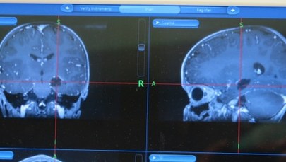 Jest szansa na terapię jednej z postaci autyzmu
