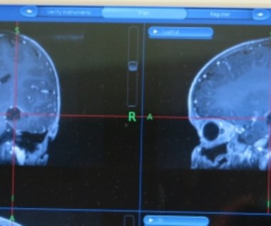 Jest szansa na terapię jednej z postaci autyzmu