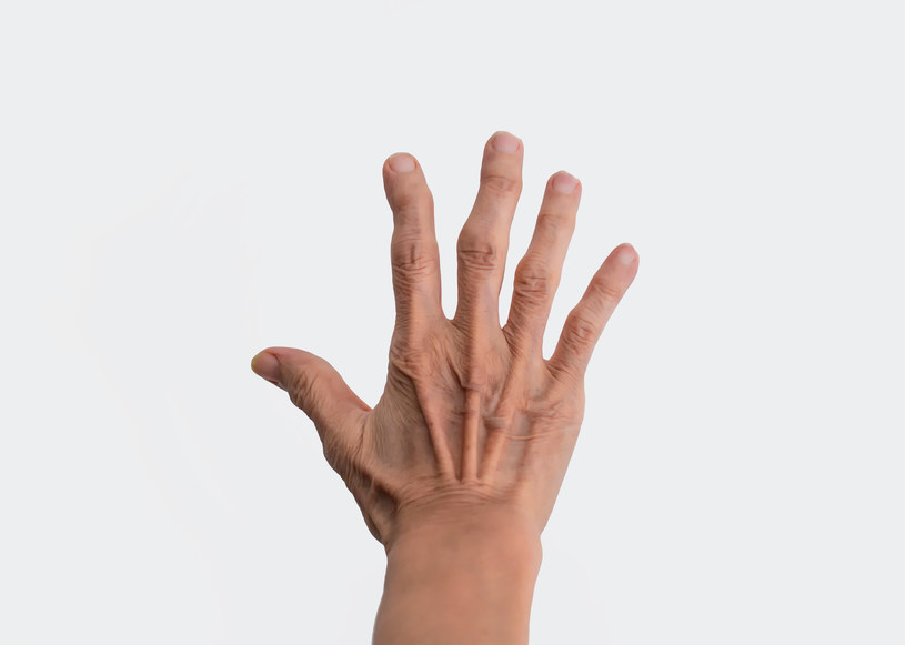 Jeżeli zespół cieśni rozwinie się w prawej dłoni, to w lewej też istnieje takie ryzyko /123RF/PICSEL