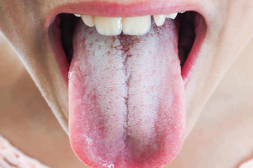 Język należy oglądać rano przed zjedzeniem śniadania i przed umyciem zębów, w dziennym świetle /123RF/PICSEL