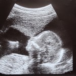 Już kilkadziesiąt ciąż w programie in vitro