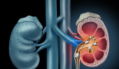 Kamica nerkowa. Pierwszym objawem ból jak od kręgosłupa