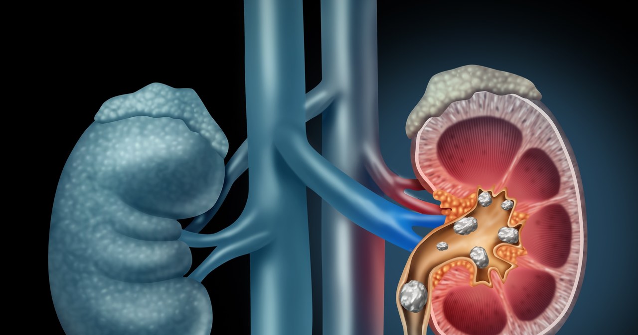Kamica nerkowa to choroba polegająca na odkładaniu się kamieni w układzie moczowym /123RF/PICSEL