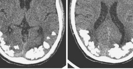 Kamienie mózgowe to efekt nieleczonej celiakii (Fot. The New England Journal of Medicine) /materiały prasowe