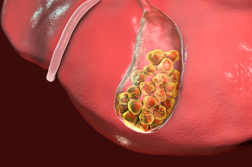 Kamienie żółciowe powstają, gdy produkowany w wątrobie cholesterol krystalizuje się /123RF/PICSEL